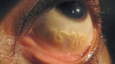 parasite in human eyes