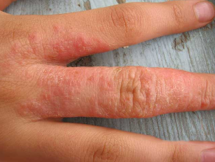 Skin rash on worms
