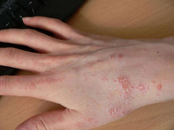 scabies on the hand subcutaneous tick